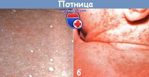 Высыпания у ребенка — потничка или аллергия? Учимся различать детскую сыпь Высыпания у ребенка — потничка или аллергия? Учимся различать детскую сыпь