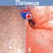Высыпания у ребенка — потничка или аллергия? Учимся различать детскую сыпь