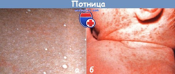 Потница у новорожденных детей